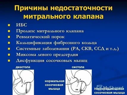 Код мкб митральный порок