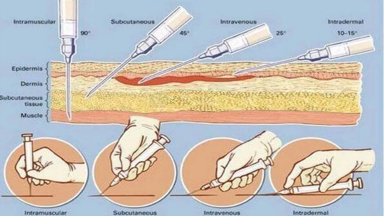 Внутрикожная глубина введения иглы. Внутримышечная инъекция как держать шприц. Введение иглы при внутримышечной инъекции. Места введения инъекций внутримышечно. Введение инъекций подкожно места введения.