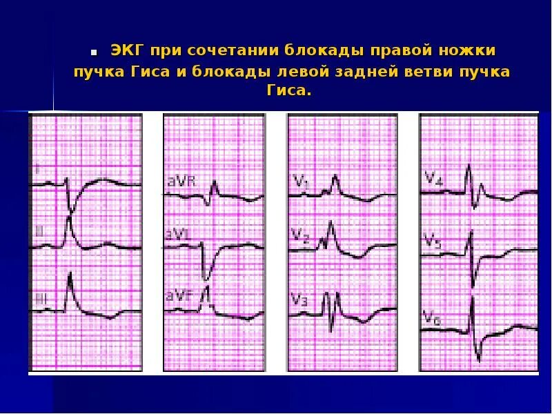 Левая ножка п гиса. Блокада ЛНПГ на ЭКГ. Блокада левой ножки пучка Гиса на ЭКГ. Блокада ПНПГ И передней ветви ЛНПГ на ЭКГ. Неполная блокада передней ветви ЛНПГ на ЭКГ.