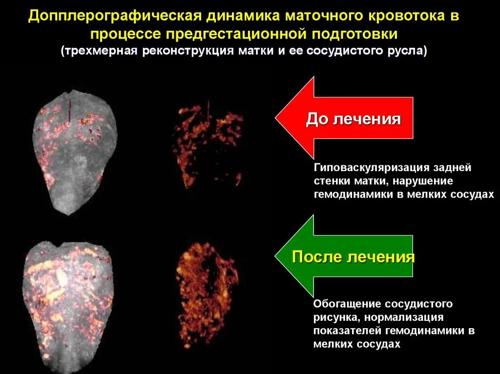 Гиповаскуляризация матки. Нарушение маточного кровотока. Цервикальная сосудистая недостаточность. Маточная гемодинамика