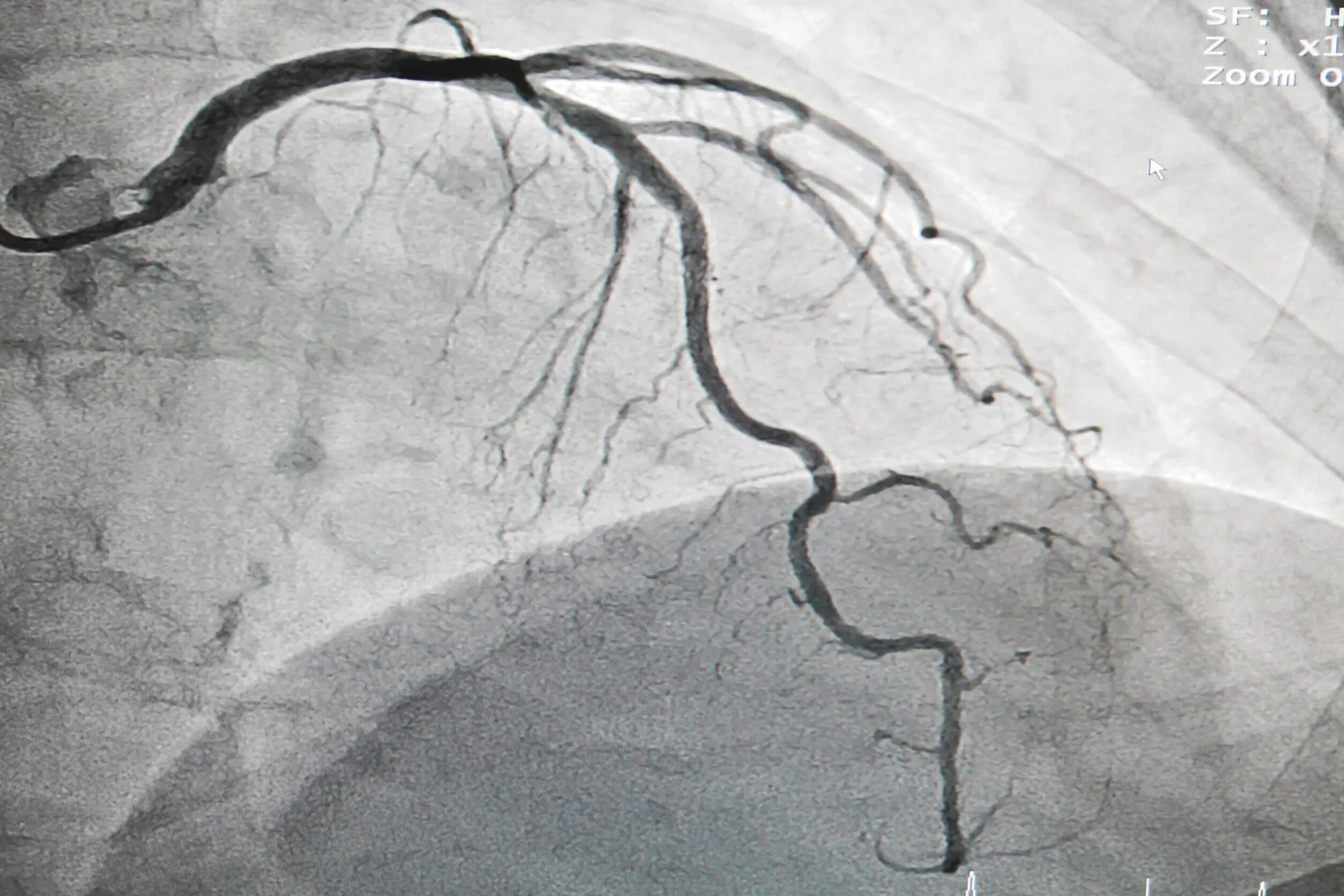 Коронарография сосудов. Coronary Angiography. Кт-коронарография сердца.