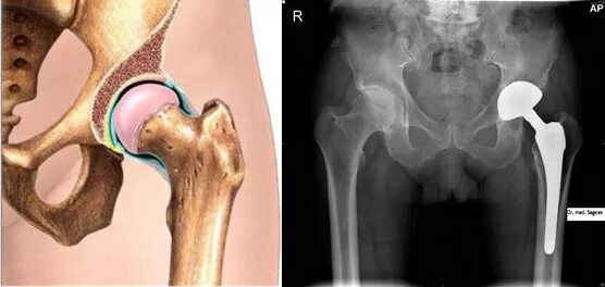 Коксартроз эндопротезирование тазобедренного сустава. Операция эндопротезирование шейки бедра. Эндопротез ТБС. Тазобедренный эндопротез Эскулап. Была операция по замене тазобедренного сустава