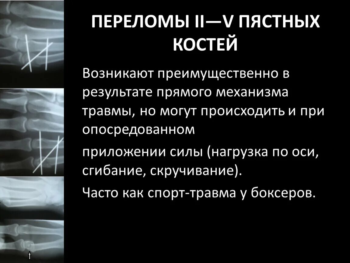 Операция пястной кости. Сагиттальный перелом пястной кости. Операция при переломе 5 пястной кости. Перелом 1 пястной кости операция. Спицы при переломе пятой пястной кости.