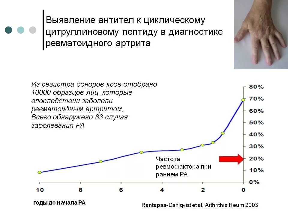 Маркеры артрита. АЦЦП ревматоидный артрит норма. Показатели АЦЦП при ревматоидном артрите. Антитела к АЦЦП норма. АЦЦП анализ крови при ревматоидном артрите.