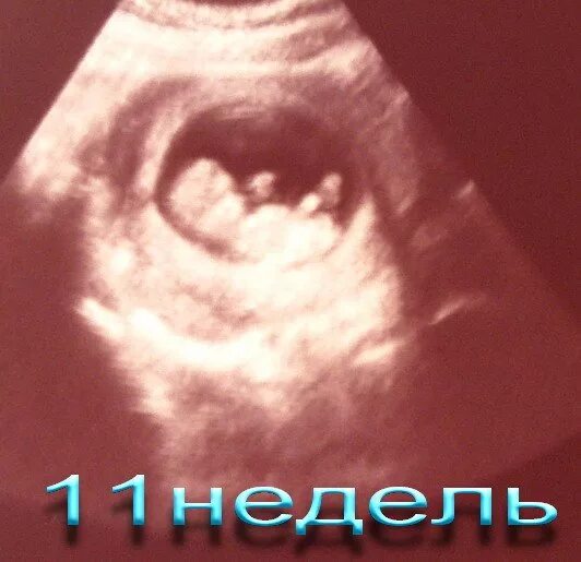 10 недель 2 дня. Узи 10-11 недель беременности. узи 10 недель беременности.