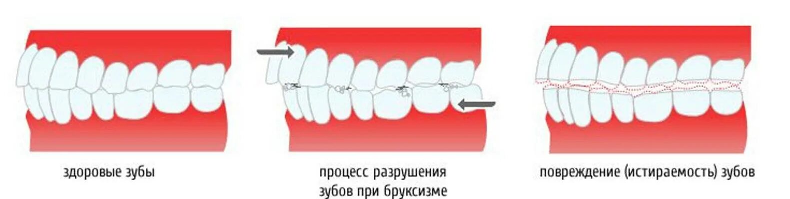 Почему сжимаются зубы. Процесс разрушение зубов при бруксизме. Бруксизм стирание зубов.