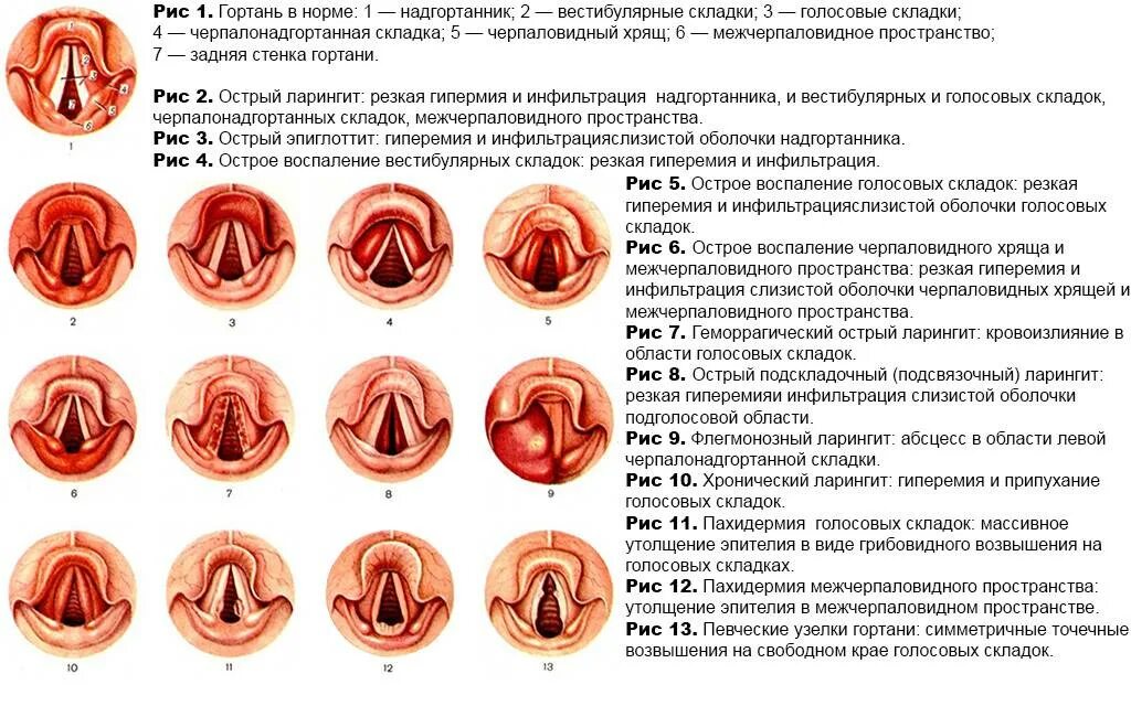 Трахеоларингит у взрослых