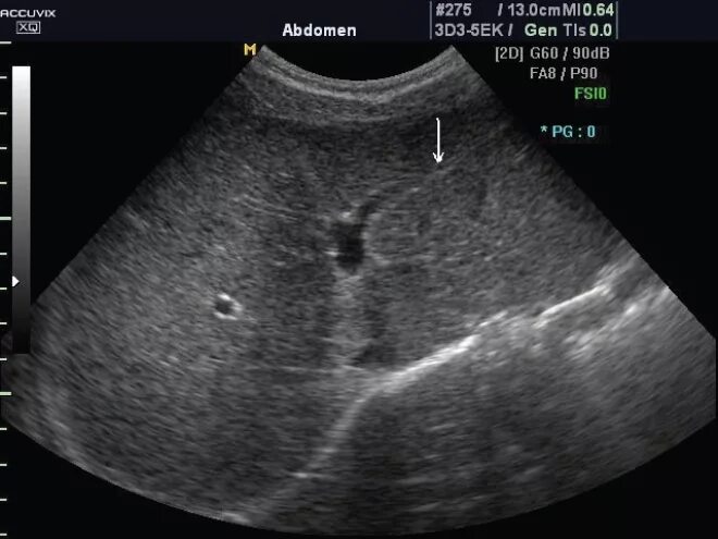 Печень узи форум. Изоэхогенные образования печени на УЗИ. Здоровая печень на УЗИ. Снимок УЗИ печени здоровой.