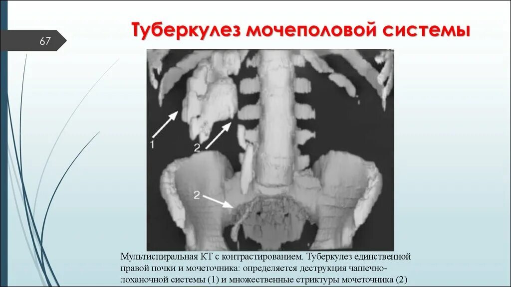 Туберкулез мочевой системы