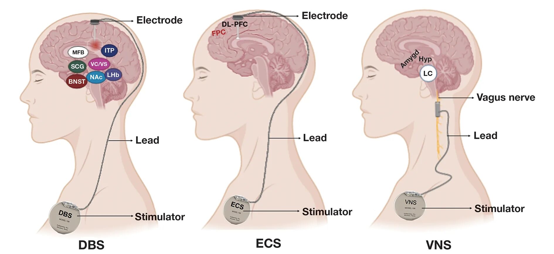 Deep brain. ДИИП брайин Стимулейшн. Mer Deep Brain stimulation. VNS.