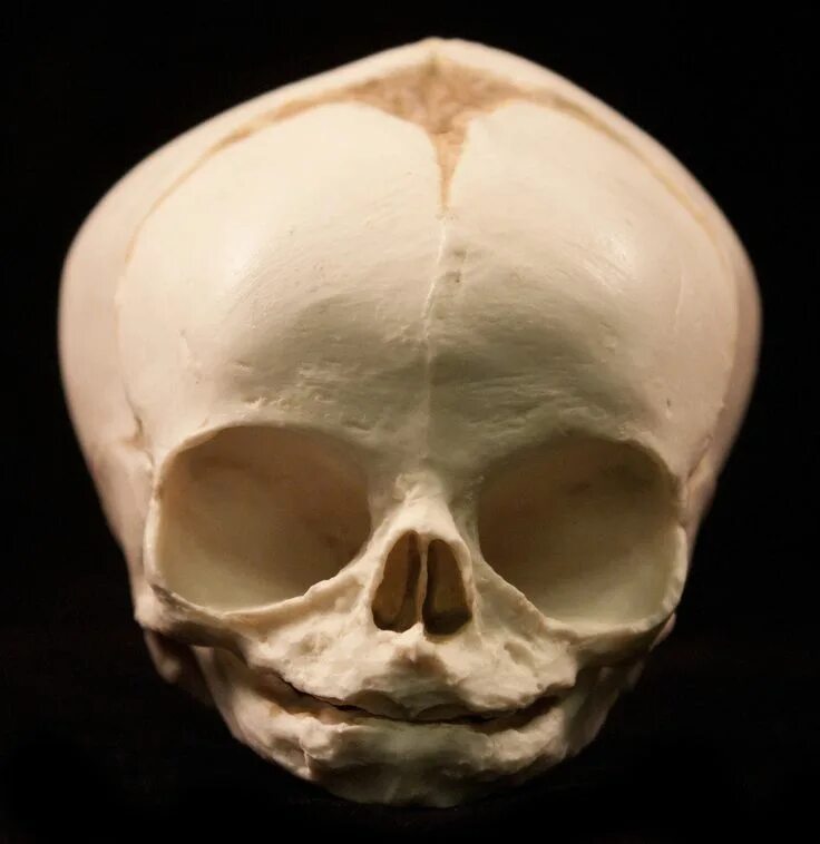 Как выглядит череп после Antibiotics for open skull fracture