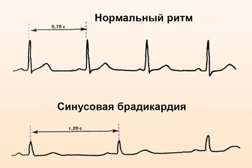 выраженная синусовая брадикардия. синусовая брадикардия характерна. брадикардия на экг. синусовая брадикардия чсс. синусовая брадикардия на экг.