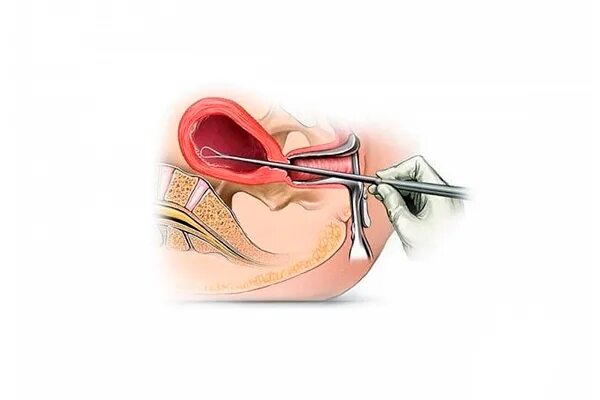 Маточное выскабливание. Раздельное диагностическое выскабливание (РДВ). Выскабливание стенок полости матки. Диагностическое выскабливание слизистой матки.