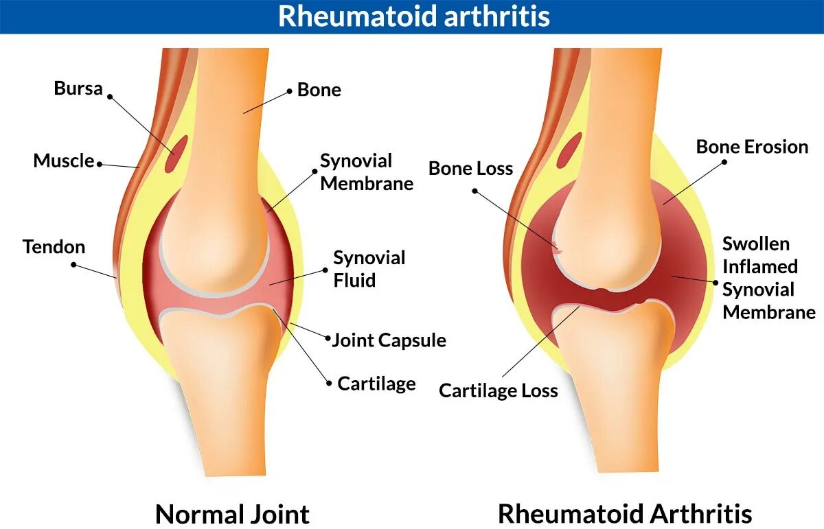 Боль под коленом спереди. Внутренняя сторона колена. Боль в колене с внутренней стороны. Воспаление коленного сустава.