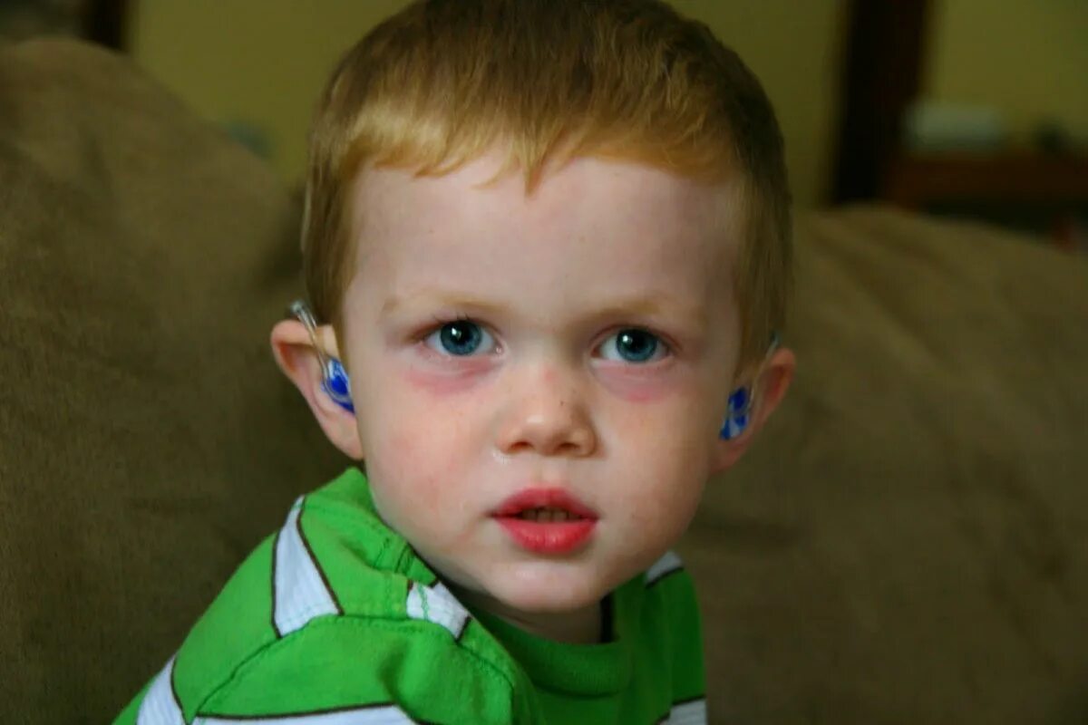 What Causes Dark Circles Under A Child's Eyes And How To Treat Them Dark circles