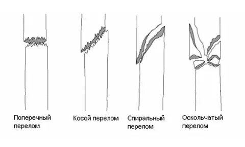 Поперечный перелом