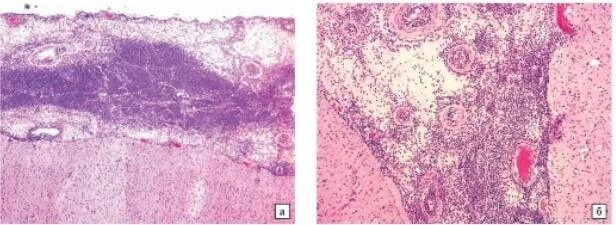 Гнойный менингит микропрепарат патанатомия. Гнойный менингит микро. Гнойный менингит макропрепарат патанатомия. Гнойный менингит микропрепарат. Гнойный мозг