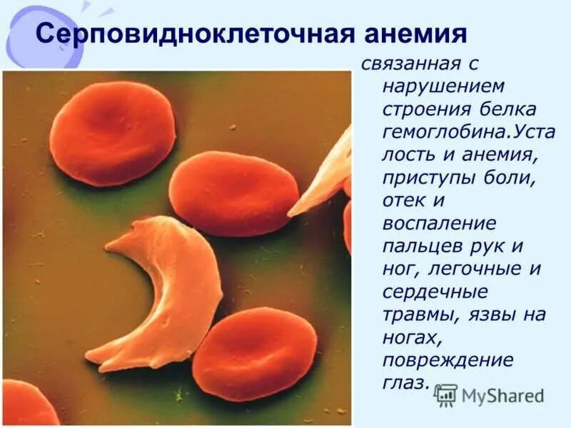 Серповидно клеточная анемия признаки. Серповидная анемия эритроциты. Серповидная клеточная анемия причины. Серповидноклеточная анемия эритроциты форма. Серповидноклеточная анемия форма гемоглобина.