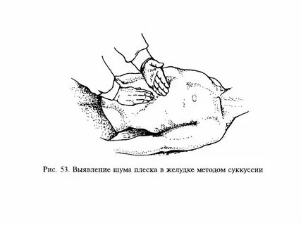 Плеск в желудке