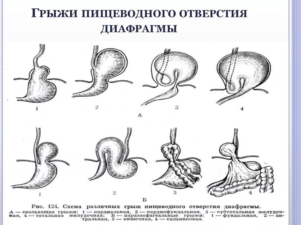 Диафрагмальный пищевода