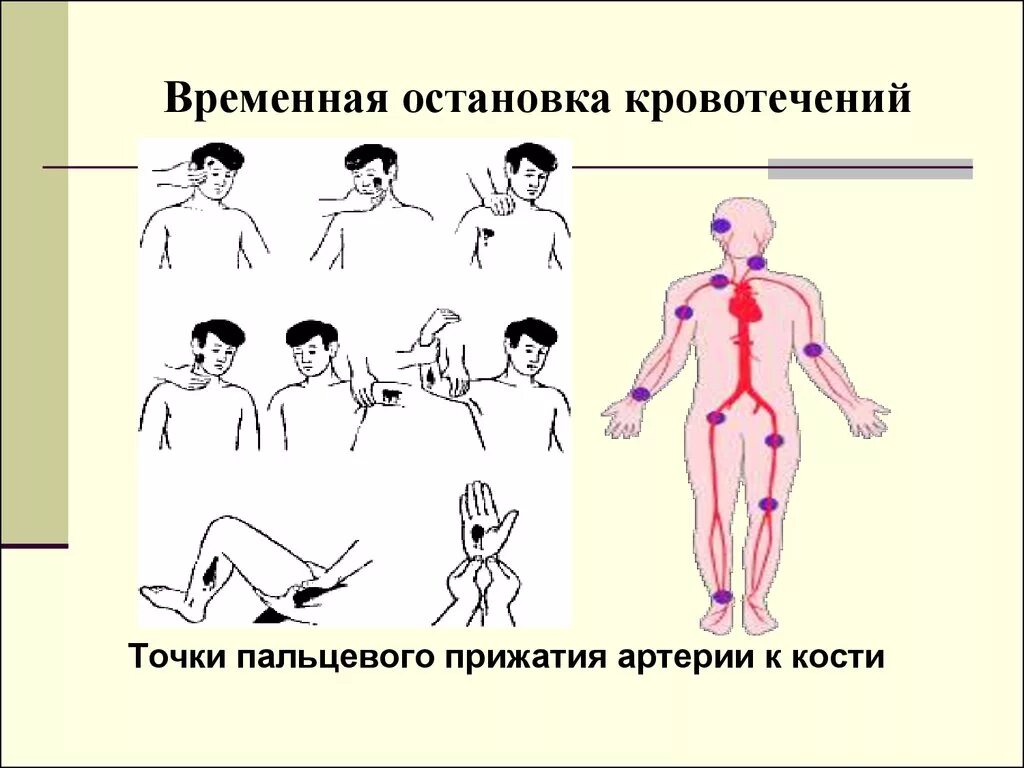 Способы остановки кровотечения пальцевое прижатие артерии. Остановка кровотечения пальцевое прижатие. Временная остановка артериального кровотечения пальцевое прижатие. Остановка кровотечения точки прижатия. Остановка кровотечения методом пальцевого прижатия артерии.