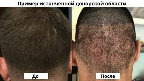 Сколько растут волосы после пересадки