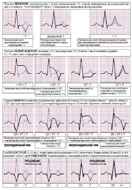 схемы по экг. экг с нуля. экг примеры. экг с нуля. экг сердца.