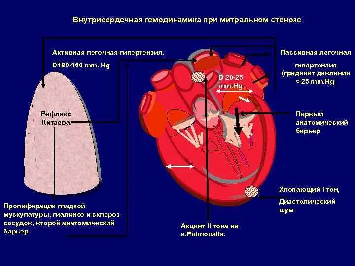 Внутрисердечная гемодинамика. Порок митрального клапана изменения гемодинамики. Синдром поражения митрального клапана гемодинамика. Стеноз митрального клапана патогенез. Митральный стеноз гемодинамика схема.