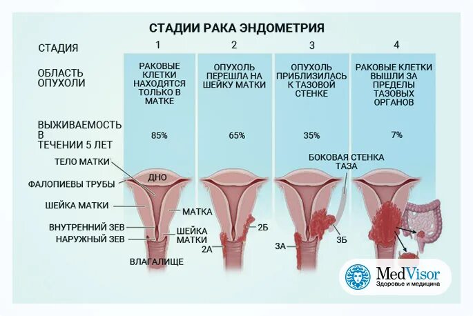 Рак 0 матки. Онкология эндометрия матки 1 стадия. Шейка матки эндометрий.