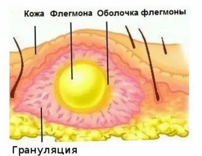 Гнойное осложнение ран