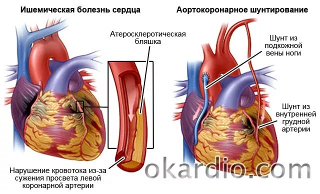 Операция на коронарные сосуды сердца. Аортокоронарное шунтирование сосудов. Операция шунтирование сосудов сердца. Аортокоронарное шунтирование (АКШ).