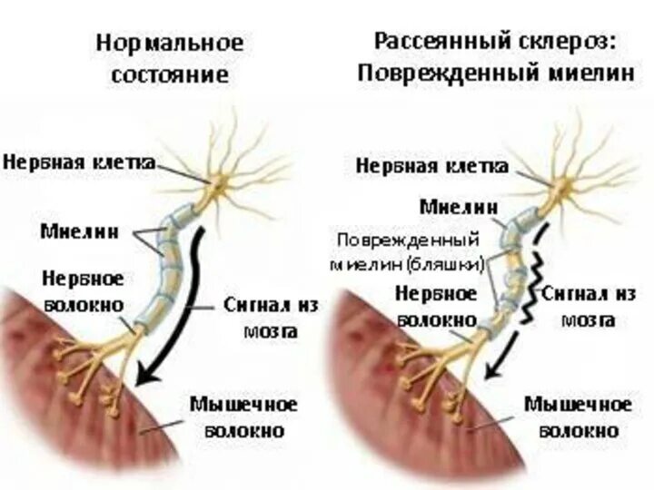 Как начинается рассеянный склероз. Рассеянный склероз. рассе́янный склеро́з. симптомы рассеянного склероза. рассеивающий склероз.