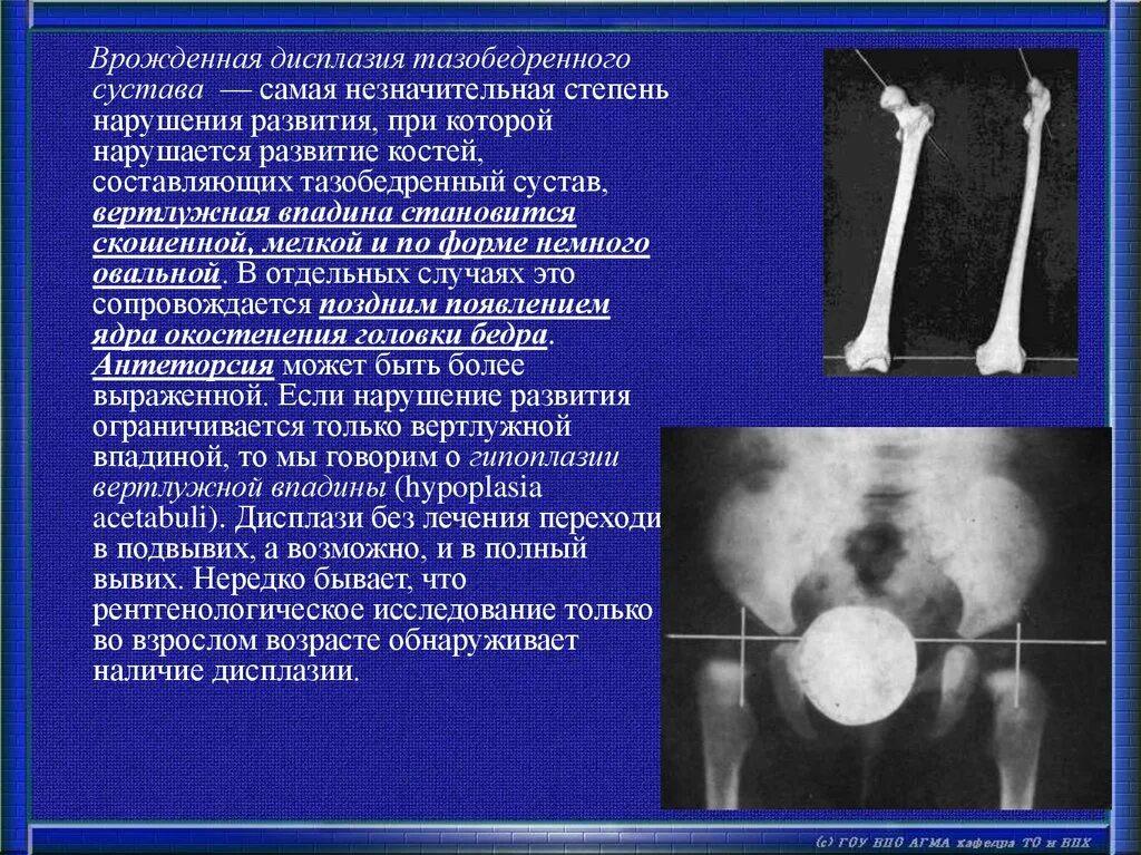 Наличия дисплазии. Дисплазия вертлужной впадины кт. Полиоссальная фиброзная дисплазия бедренной кости. Врожденная дисплазия тазобедренных суставов. Дисплазия костей и суставов.