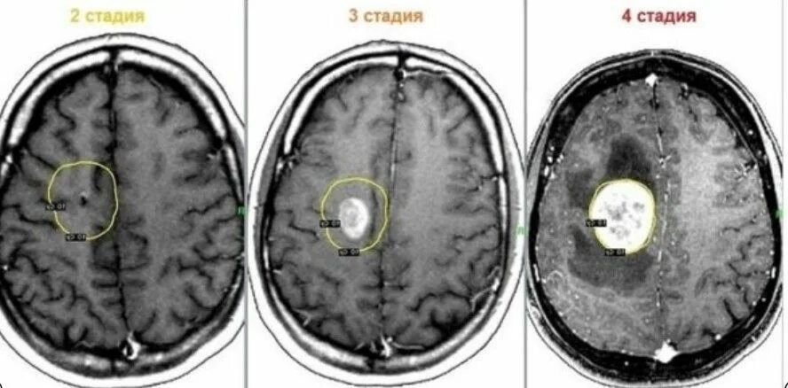 Рак мозга степени. Опухоль головного мозга глиобластома. Опухоль головного мозга глиобластома 4. Глиобластома лобной доли. Глиобластома мультиформная степень 4.