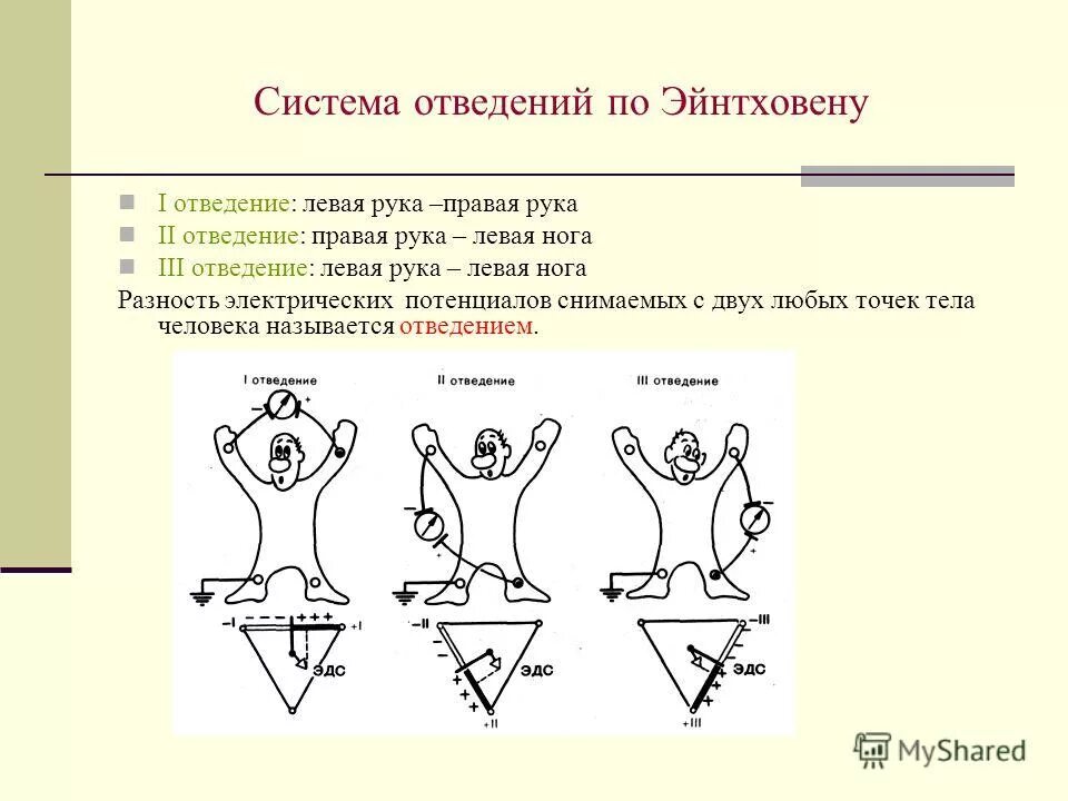 Схема стандартных отведений (по эйнтховену). Отведения i ii ii. Экг во 2 стандартном отведении. 3 стандартное отведение экг. 3 стандартное отведение экг.