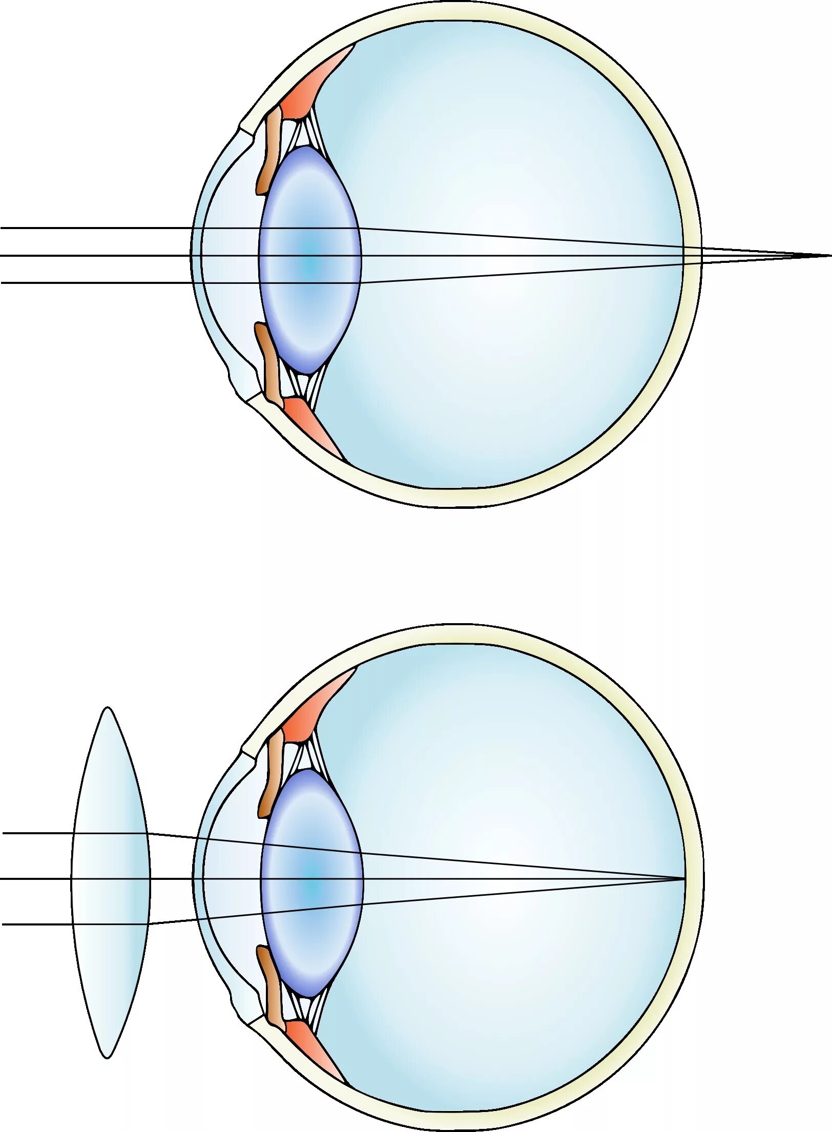 Фокусировка лучей света на внутренней поверхности глазного. Зрение близорукость и дальнозоркость. Глаз при близорукости и дальнозоркости. Близорукость схема глаза. Близорукость и дальнозоркость линзы.