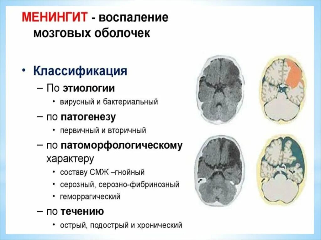 Менингит последствия у взрослых. Вторичный Гнойный менингит классификация. Поражение мозговых оболочек при менингите. Очаг поражения менингита. Гнойный менингит (бактериальный менингит).