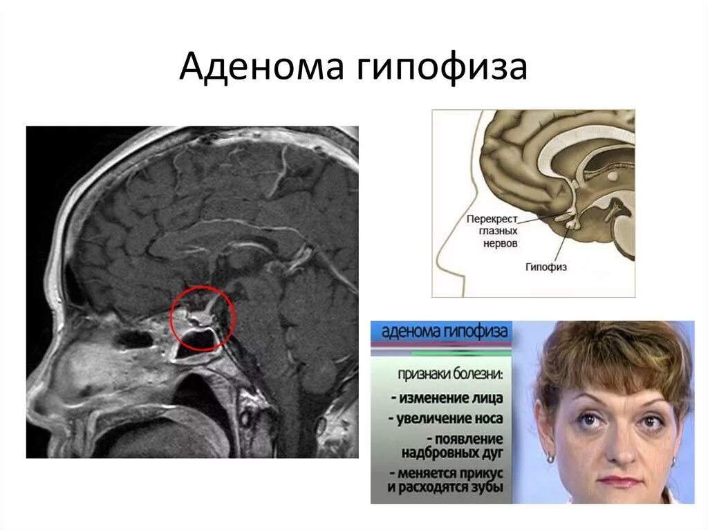 Симптомы гипофиз у мужчин. Соматотропная аденома гипофиза. Супраселлярная аденома гипофиза мрт. Кистозная форма аденомы гипофиза мрт. Аденома гипофиза гормонально активная.