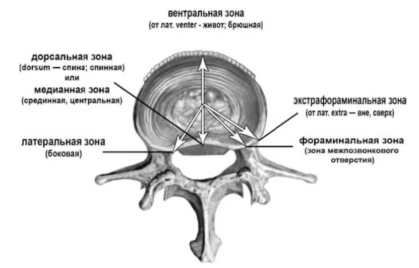 Медианно парамедианная билатеральная. Межпозвонковые диски l4-l5. Задняя медианная грыжа l2 l3. Пятый позвонок поясничного отдела грыжа. Грыжи позвоночника в поясничном отделе схема.