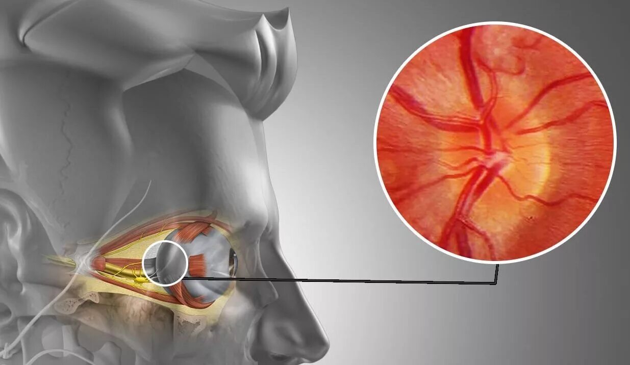 Неврит зрительного нерва. Ишемическая нейропатия зрительного нерва. Нейропатия зрительного нерва Лебера. Интрабульбарный отдел зрительного нерва. Нейропатия глаза