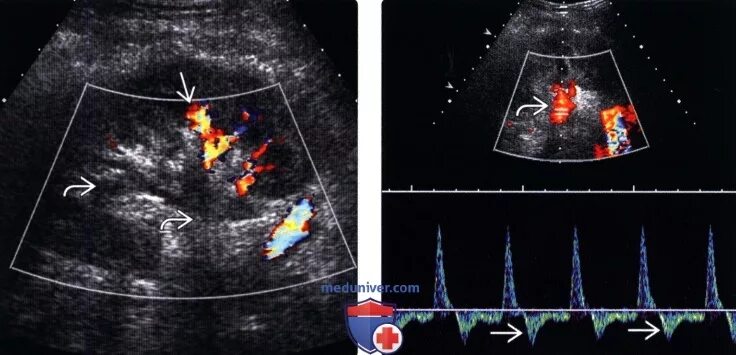 Тромбоз почечной вены УЗИ. Тромбоз почечных вен на УЗИ. Допплерография сосудов почек. Тромбоз почечной вены