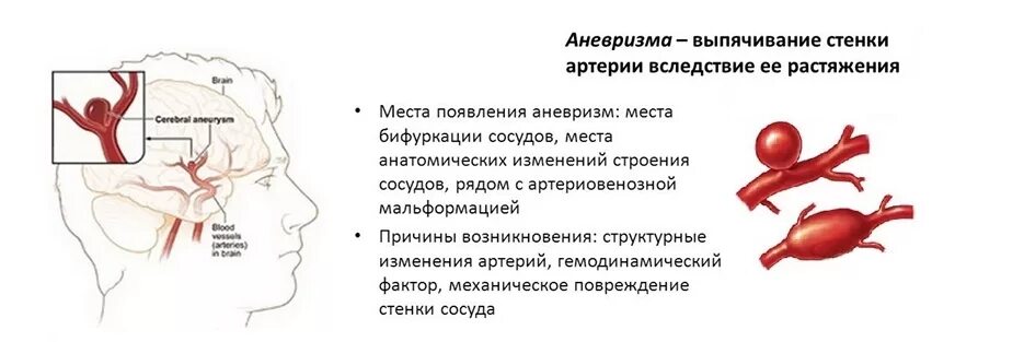 Артерии головного мозга симптомы. Аневризма базилярной артерии симптомы. Мешотчатая аневризма базилярной артерии. Разрыв аневризм артерий головного мозга.. Симптомы разрыва аневризмы ГМ.