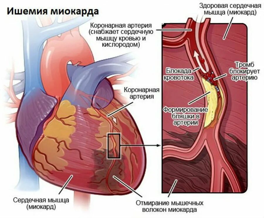 St ишемия. Ишемическая болезнь сердца стенокардия инфаркт миокарда. ИБС относится стенокардия, инфаркт миокарда. ИБС сердца и стенокардию. STENAKORDIA.