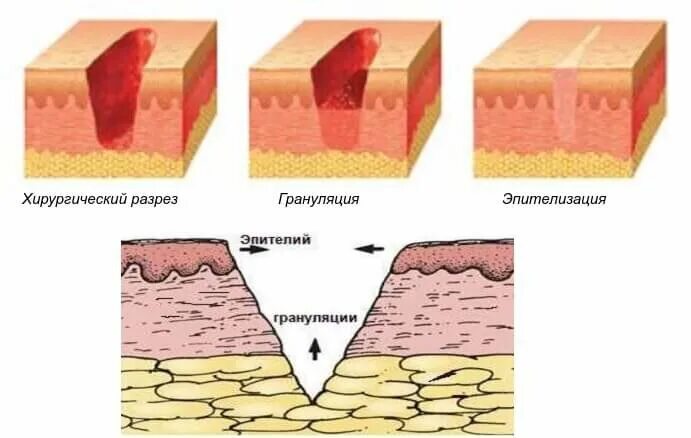 Сколько заживает глубокий. Этапы заживления послеоперационных РАН. Стадии заживления РАН после операции. Заживления РАН грануляция. Этапы заживления послеоперационной раны.