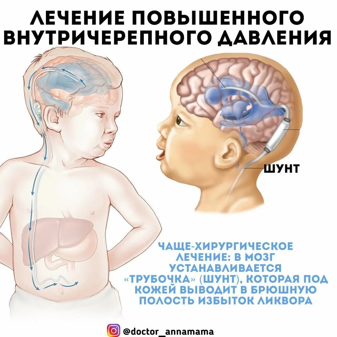 Диета при гидроцефалии мозга. Давление у грудничков внутричерепное давление. Внутричерепное давление у ребенка 1 год. Черепное давление симптомы у детей. Внутреннее черепное давление.