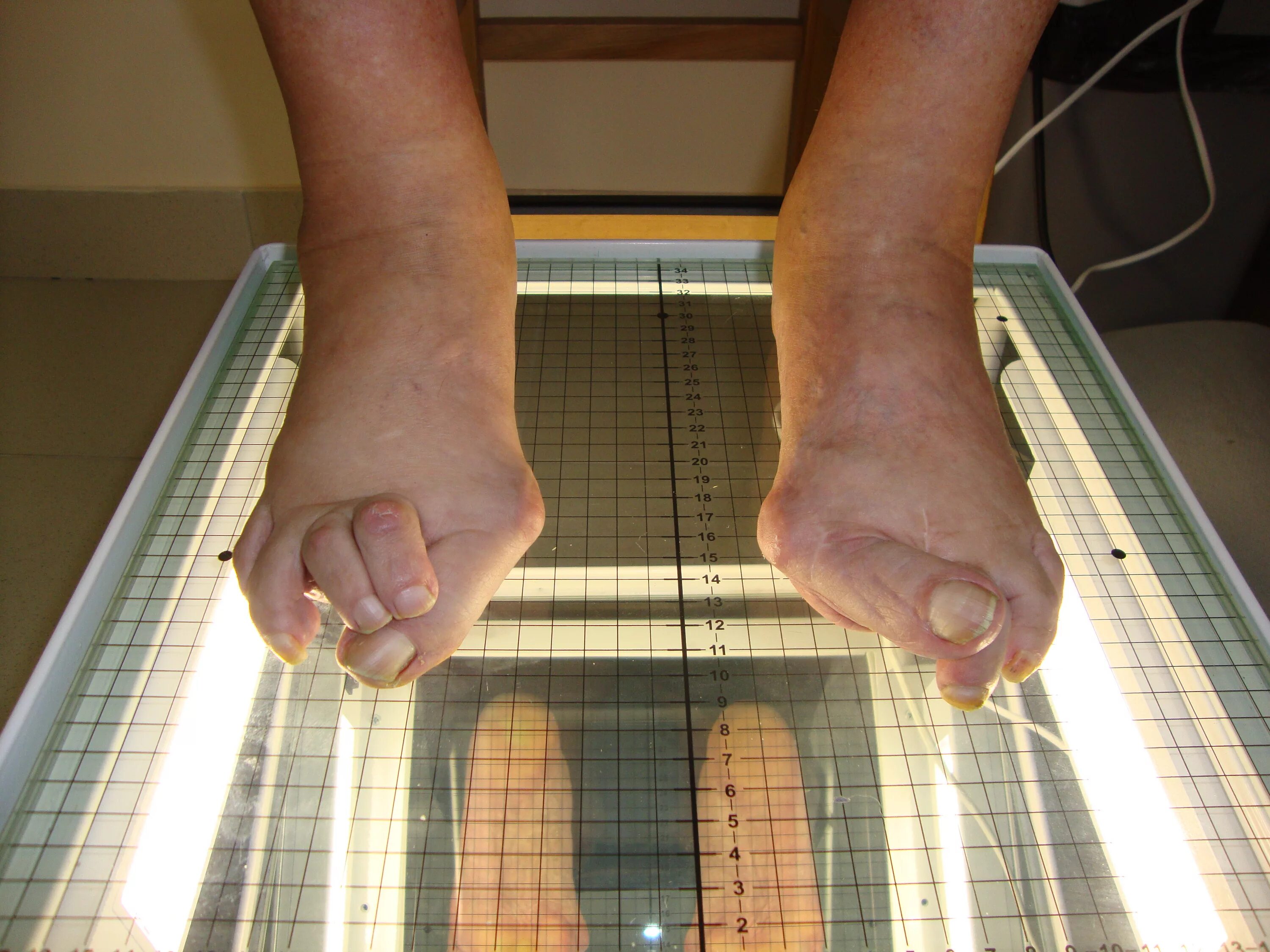 Поперечное плоскостопие 1 пальца. Поперечное плоскостопие деформация. Симптомы продольного и поперечного плоскостопия. Своды стопы продольной и поперечной плоскостопие. Плоскостопие продольное и поперечное 2.