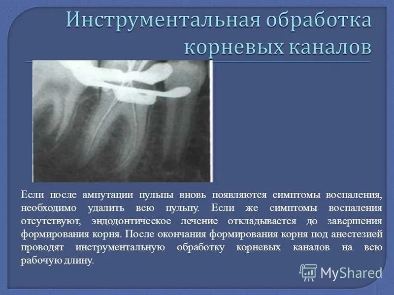 Обработка корневых каналов техники
