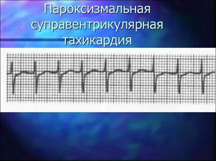 Пароксизмальная наджелудочковая тахикардия