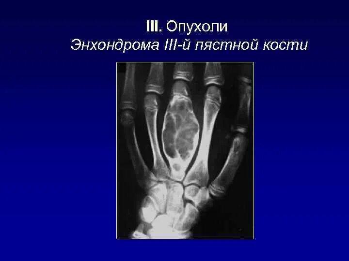 Энхондрома фаланги пальца. Опухоль пястной кости рентген. Энхондрома диафиза бедренной кости. Энхондрома полулунной кости. Энхондрома ладьевидной кости кисти.