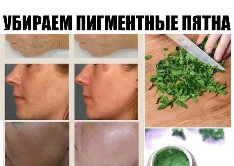 Как удалить пигментные пятна. Петрушка для отбеливания пигментных пятен. сок петрушки от пигментных пятен. петрушка для лица от пигментных пятен. как убрать пигментные пятна.